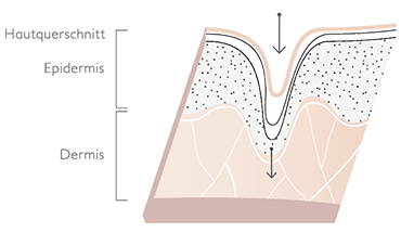 Wirkung Micro-Needling1