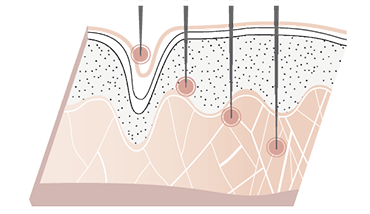 Wirkung Micro-Needling2