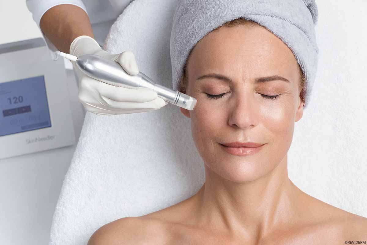 microneedling behandlungen